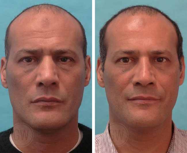 Rhinoplasty – Narrowing of nasal vault