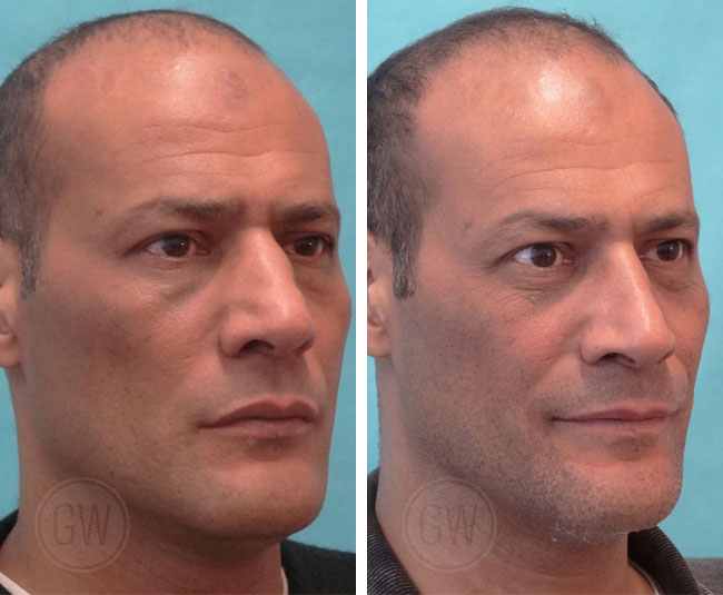 Rhinoplasty – Narrowing of nasal vault