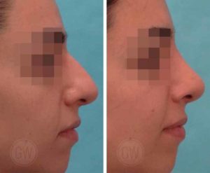 Rhinoplasty – Dorsal hump reduction