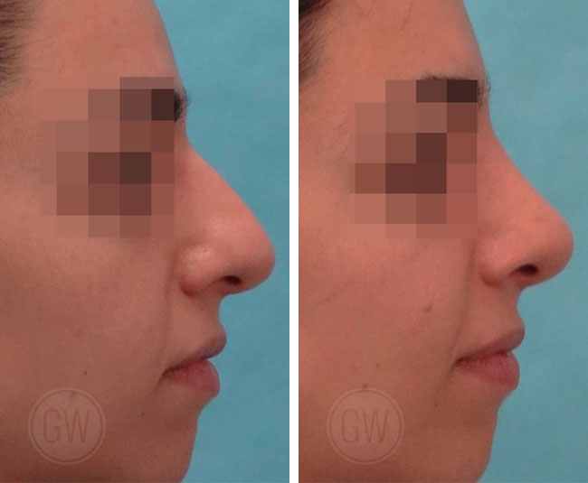 Rhinoplasty – Dorsal hump reduction