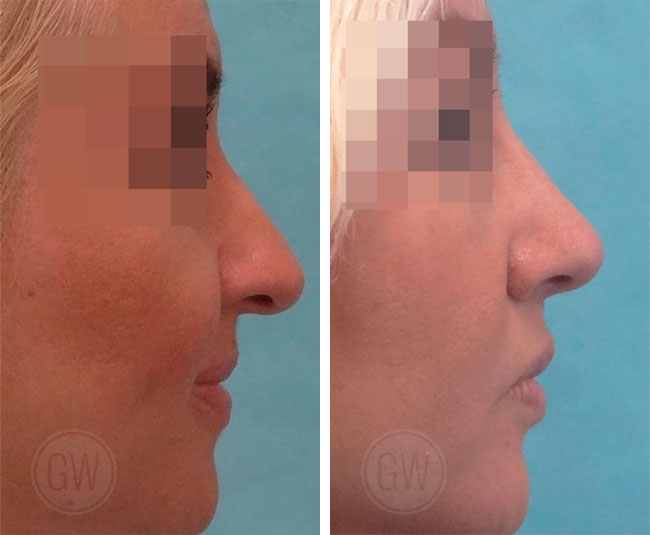 Rhinoplasty – Dorsal hump reduction + Nasal tip elevation