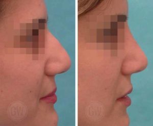 Rhinoplasty – Dorsal hump reduction