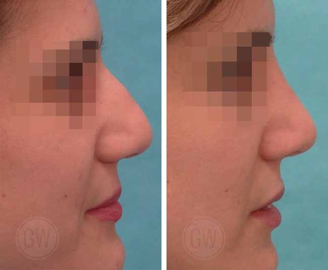 Rhinoplasty – Dorsal hump reduction