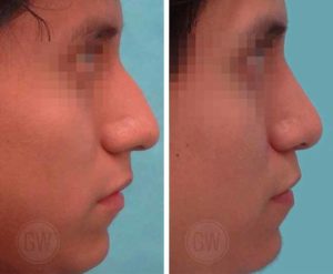 Rhinoplasty – Dorsal hump reduction