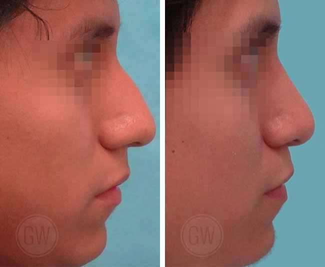 Rhinoplasty – Dorsal hump reduction