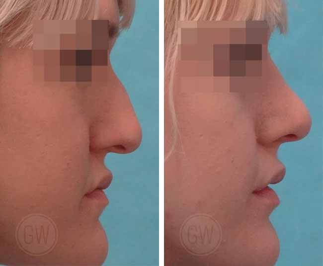 Rhinoplasty – Dorsal hump reduction + Nasal tip elevation