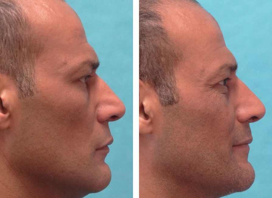 Rhinoplasty – Narrowing of nasal vault