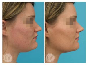 Rhinoplasty + Reduction Genioplasty + Submental Liposuction