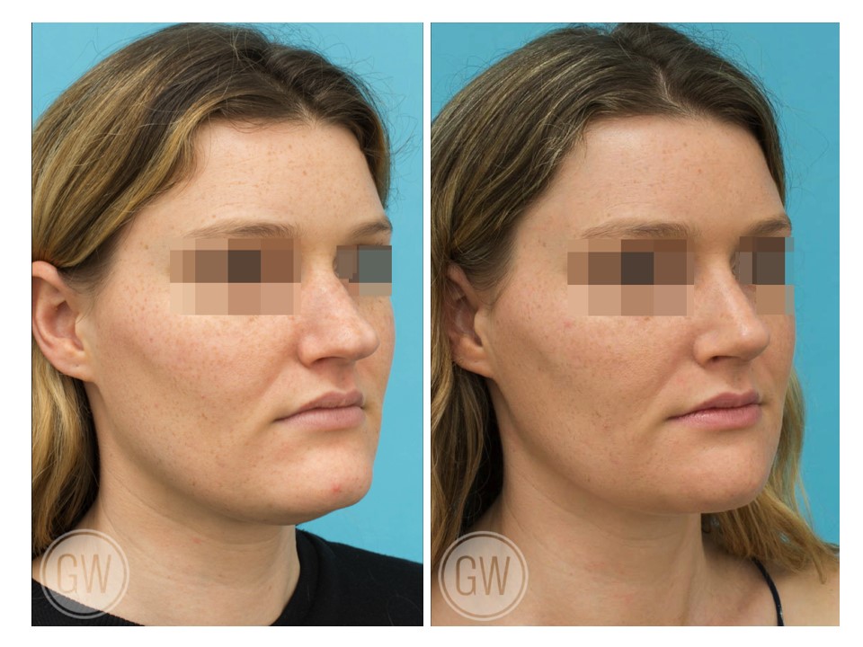 Rhinoplasty + Reduction Genioplasty + Submental Liposuction