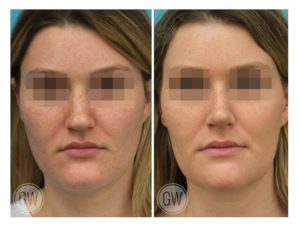 Rhinoplasty + Reduction Genioplasty + Submental Liposuction