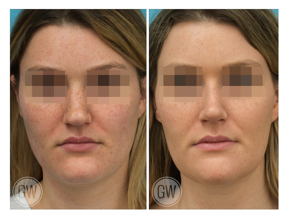 Rhinoplasty + Reduction Genioplasty + Submental Liposuction