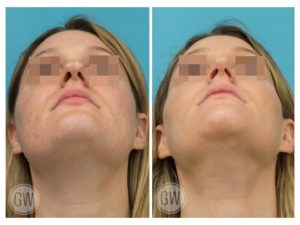 Rhinoplasty + Reduction Genioplasty + Submental Liposuction
