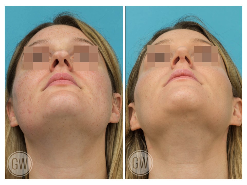 Rhinoplasty + Reduction Genioplasty + Submental Liposuction