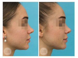 Rhinoplasty