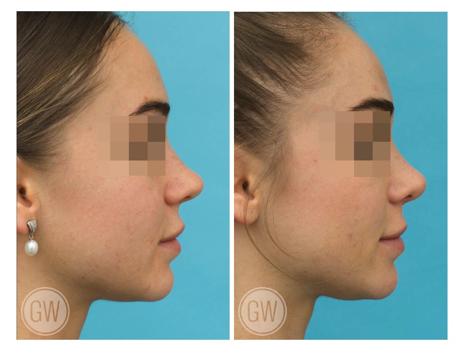 Rhinoplasty
