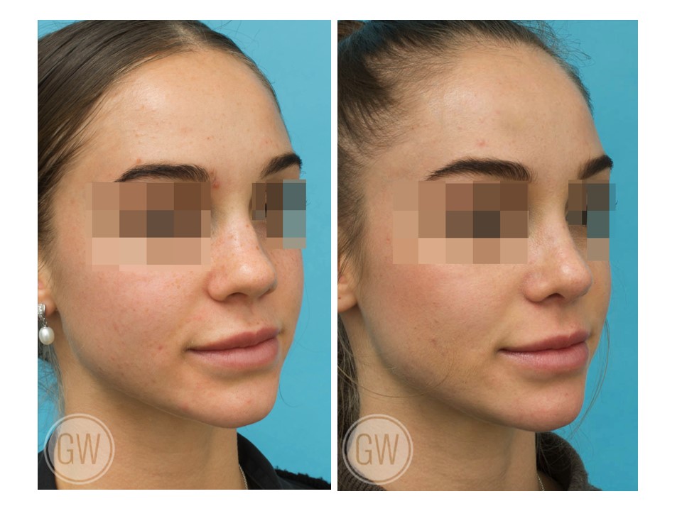 Rhinoplasty