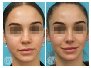 Rhinoplasty