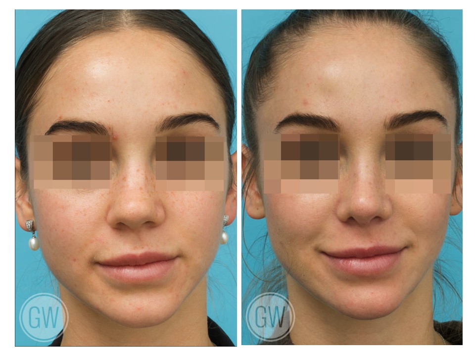 Rhinoplasty