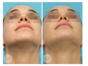 Rhinoplasty