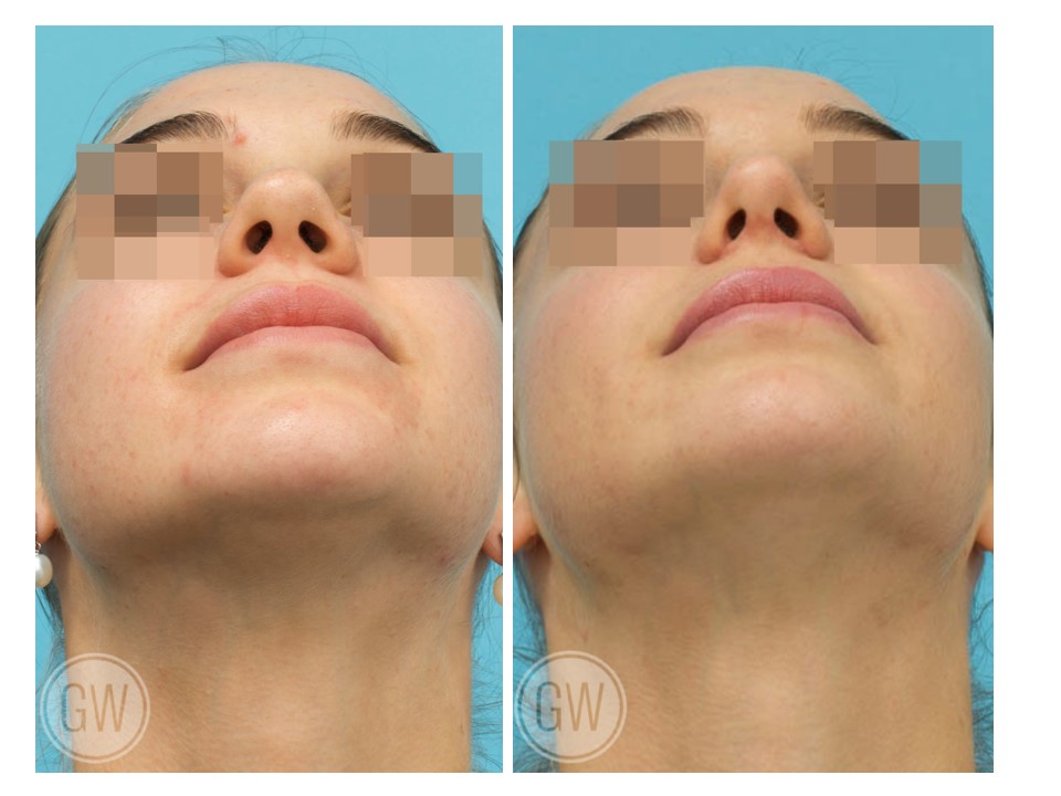 Rhinoplasty