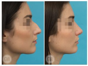 Rhinoplasty + Septoplasty