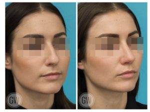 Rhinoplasty + Septoplasty