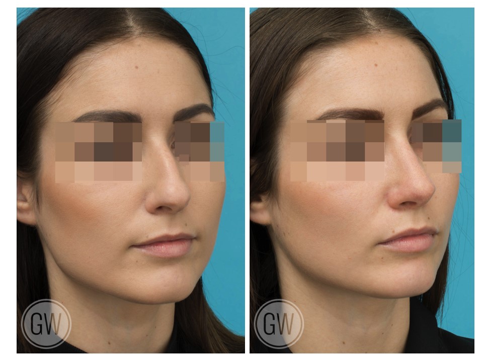 Rhinoplasty + Septoplasty