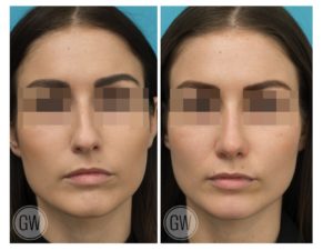 Rhinoplasty + Septoplasty