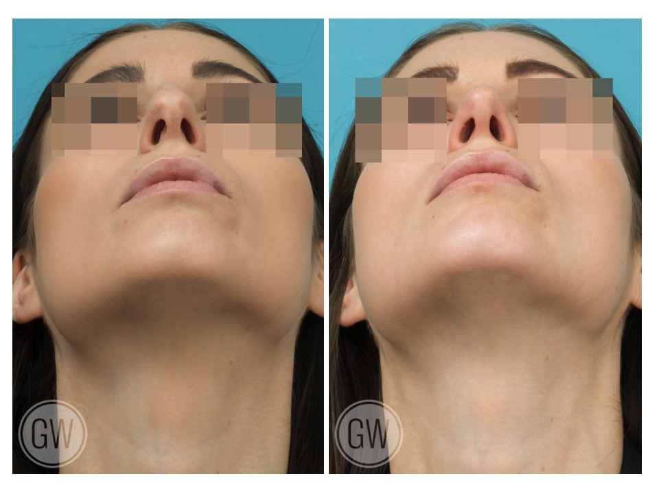 Rhinoplasty + Septoplasty