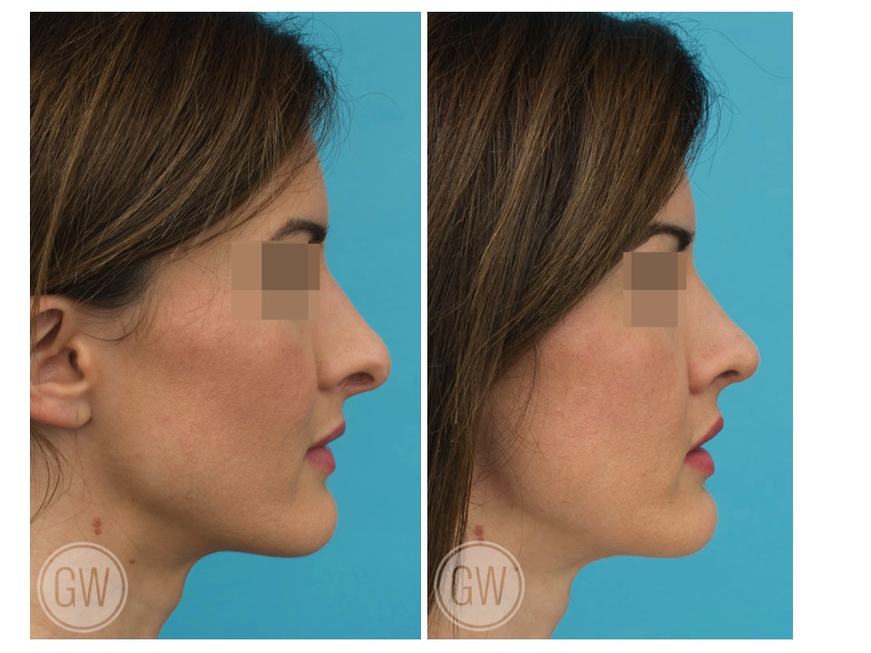 Rhinoplasty + Septoplasty