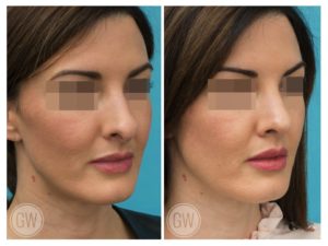 Rhinoplasty + Septoplasty