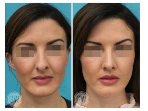 Rhinoplasty + Septoplasty