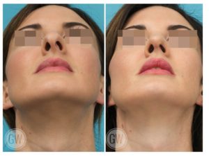 Rhinoplasty + Septoplasty