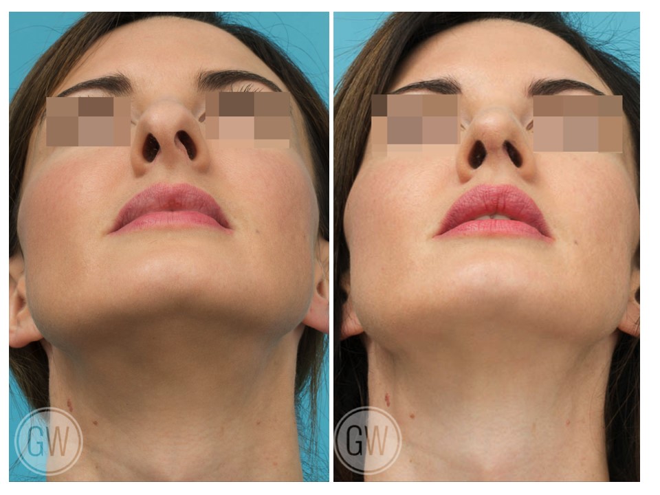 Rhinoplasty + Septoplasty