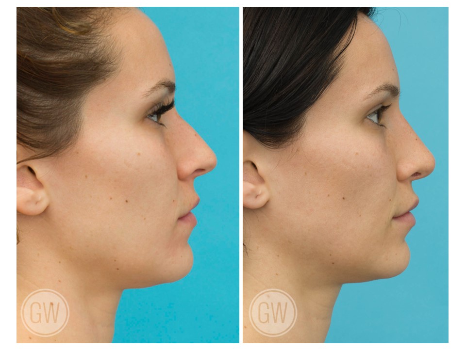 Rhinoplasty + Septoplasty + Alar Base Reduction