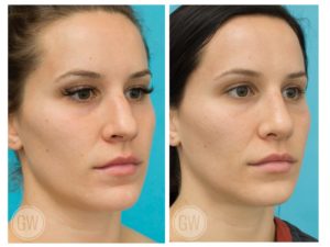 Rhinoplasty + Septoplasty + Alar Base Reduction