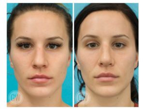 Rhinoplasty + Septoplasty + Alar Base Reduction