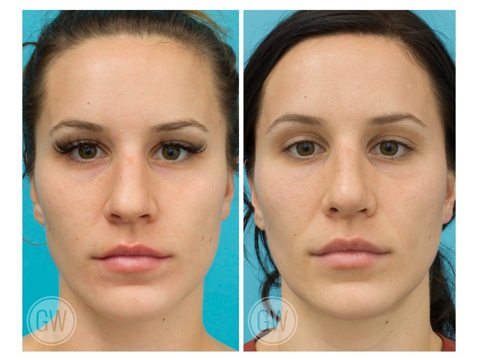 Rhinoplasty + Septoplasty + Alar Base Reduction