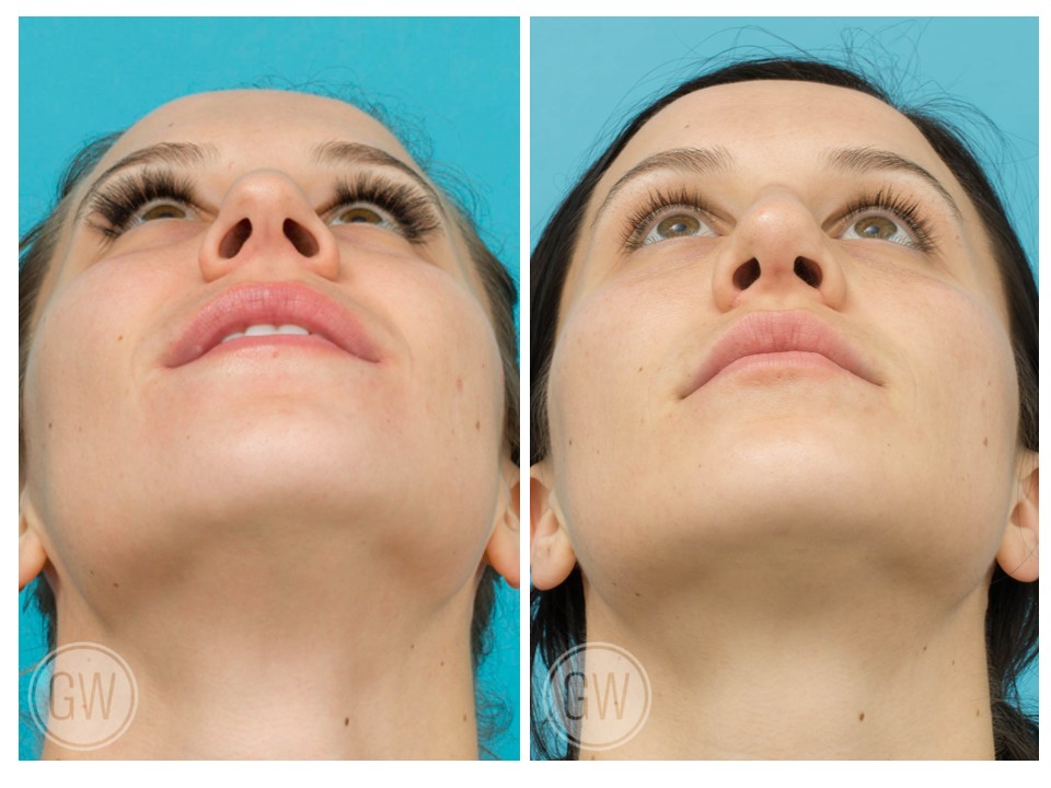 Rhinoplasty + Septoplasty + Alar Base Reduction