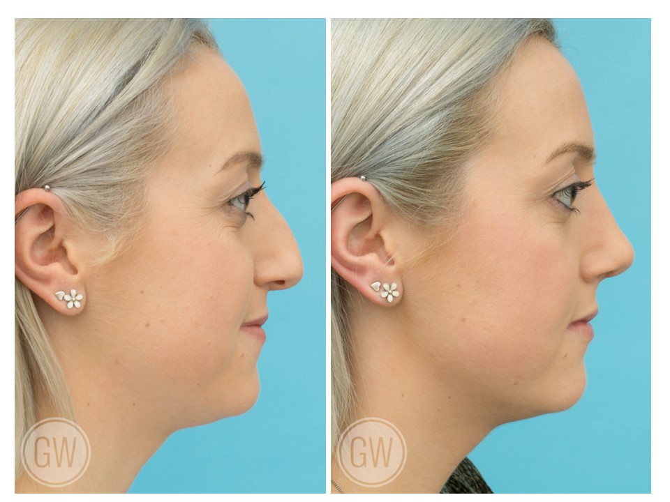 Rhinoplasty + Septoplasty