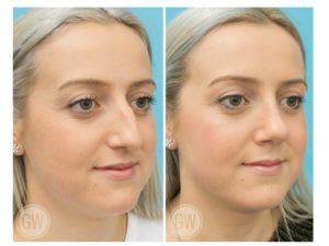 Rhinoplasty + Septoplasty