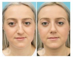 Rhinoplasty + Septoplasty
