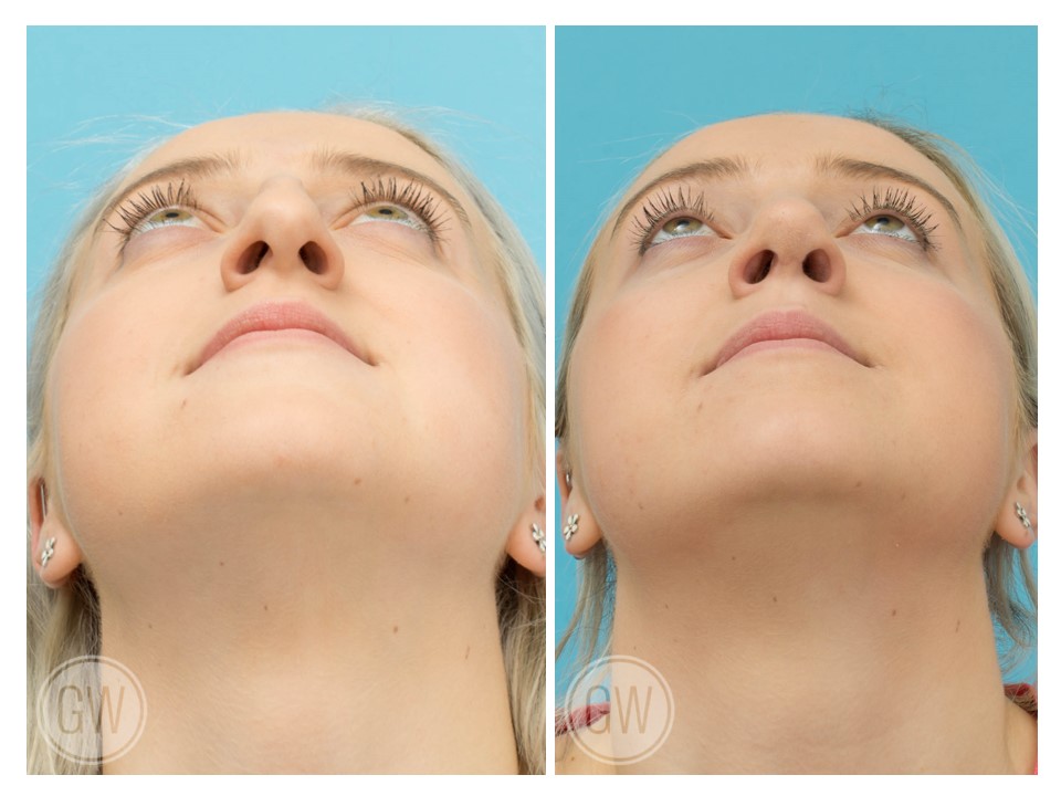 Rhinoplasty + Septoplasty