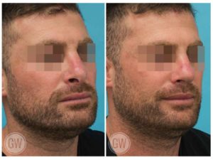 Revision Rhinoplasty + Septoplasty