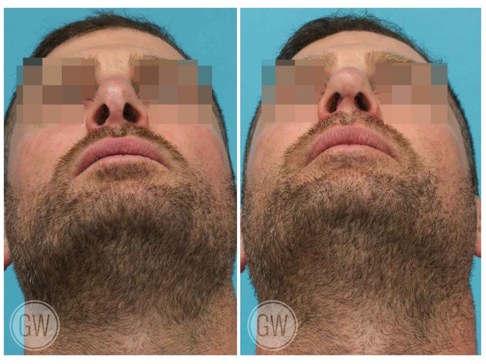 Revision Rhinoplasty + Septoplasty