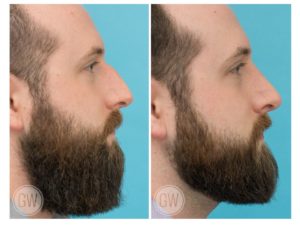 Rhinoplasty + Septoplasty