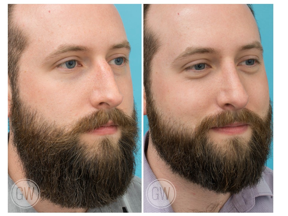 Rhinoplasty + Septoplasty