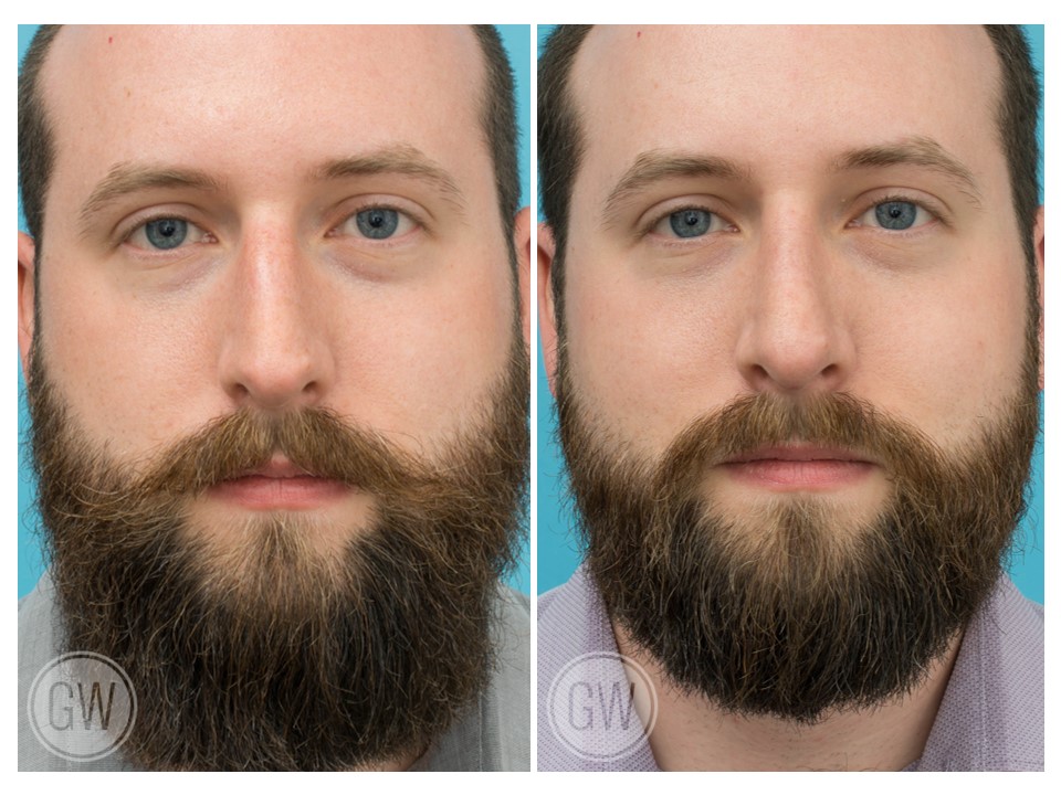 Rhinoplasty + Septoplasty