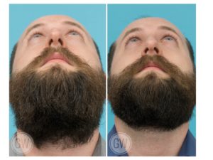 Rhinoplasty + Septoplasty