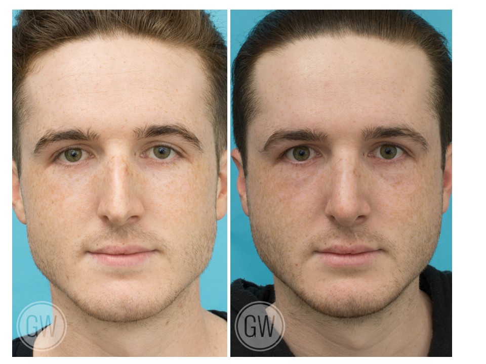 Rhinoplasty + Septoplasty